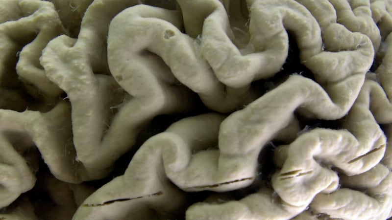 ARCHIVO - Un cerebro humano afectado por la enfermedad de Alzheimer se ve expuesto en el Museo...